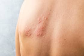 You should get advice from 111 as soon as possible if you think you have shingles