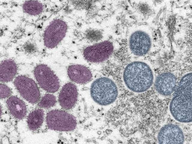 Monkeypox pathogen. Credit: UKHS