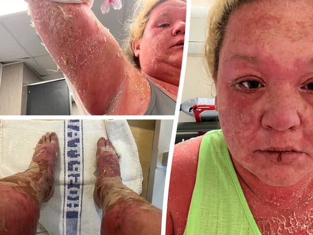 Woman's extreme allergic reaction to mosquito bite on holiday in the Caribbean 