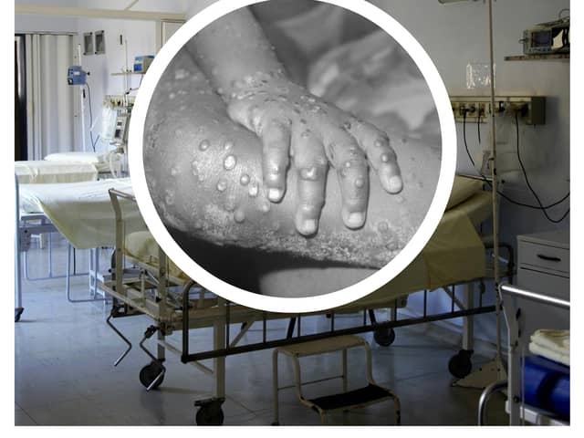 The WHO has declared a global health emergency over a mpox outbreak. (Photo: Pixabay, CDC/Getty Images)