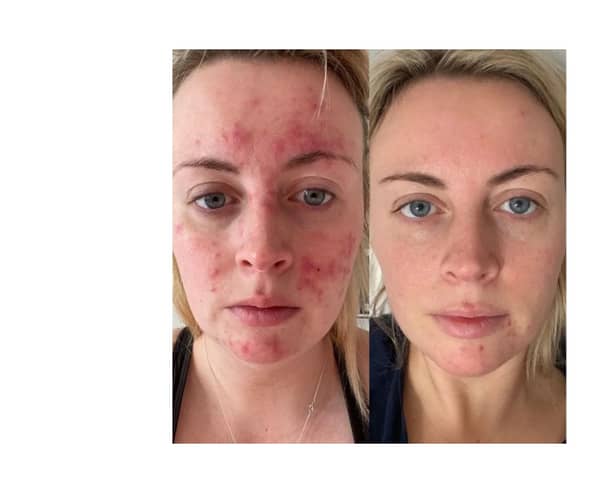 Abigail's results 47 Skin 
