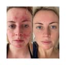 Customers share amazing before and after results of skincare brand that took the world by storm - Abigail's results 47 Skin 
