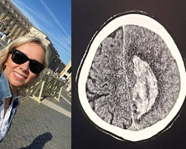 Alicja Faryniarz was diagnosed AVM after suffering what she thought were ‘work stress’ headaches.
