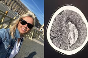 Alicja Faryniarz was diagnosed AVM after suffering what she thought were ‘work stress’ headaches.