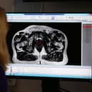 The scan of a patient diagnosed with prostate cancer