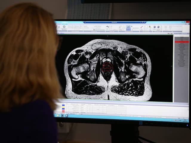 The scan of a patient diagnosed with prostate cancer